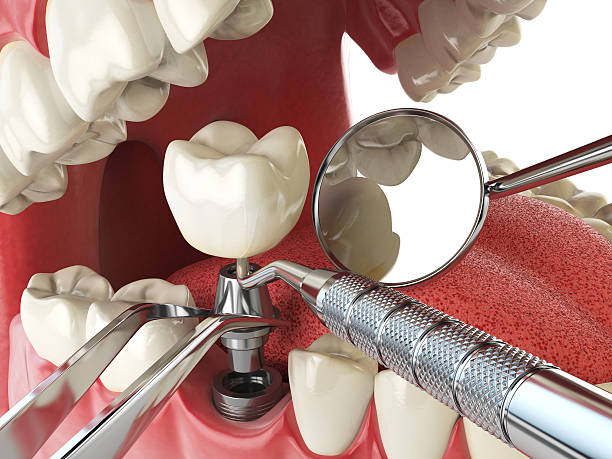 Best Emergency Dental Care for Abscessed Tooth in Lecanto, FL